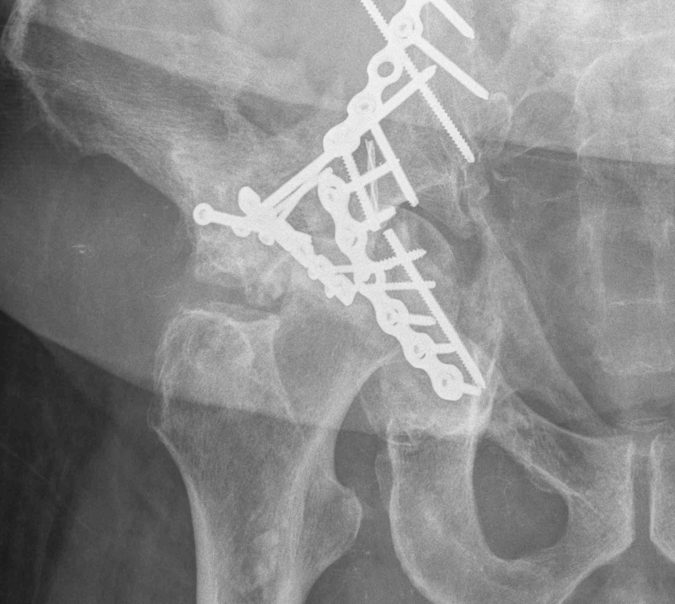 Acetabular Fracture Failed ORIF 2